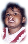Upper lip Cleft - Pre-operative
