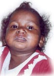 Upper lip Cleft - Post-operative